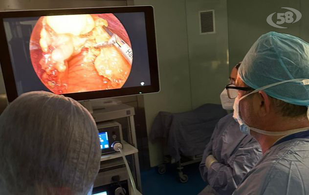 Resezione epatica laparoscopica, intervento all’avanguardia al Fatebenefratelli