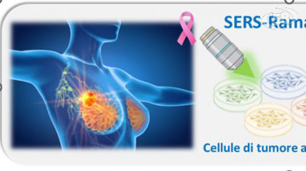 Lotta al cancro, arriva un nuovo screening per la diagnosi e la terapia del tumore al seno