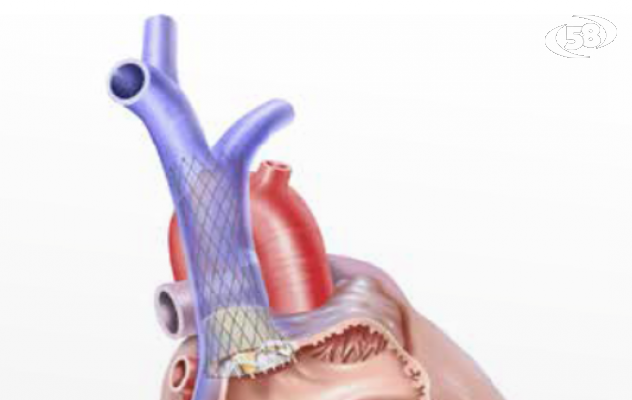 Impianto percutaneo di valvola tricuspide al Fatebenefratelli, è tra i primi interventi nel Sud Italia